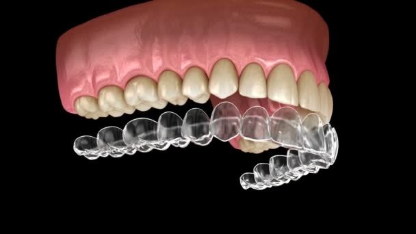 depositphotos_329058746-stock-video-teeth-whitening-with-invisalign-braces
